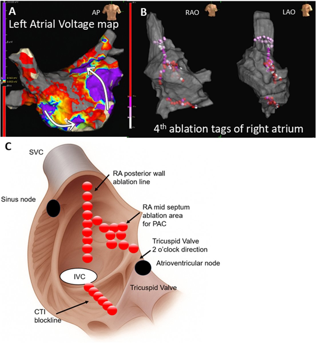 HRS_CaseReports's tweet photo. Dual-site atrial lead configuration restores intra-atrial synchrony in sinus node isolation due to intra-atrial conduction block after extensive atrial ablation
https://t.co/1fYginKXCO https://t.co/m2usi9UICr
