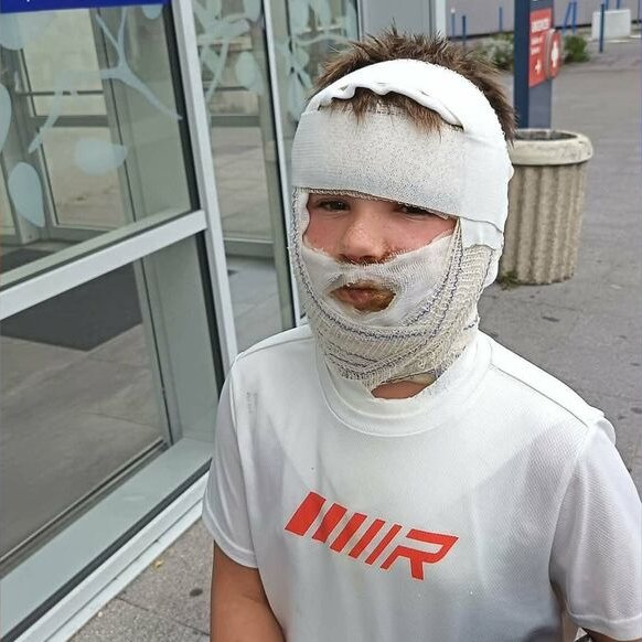 thenews_fr's tweet photo. 🇫🇷⚠️ ALERTE – Une balle antistress lui a brûlé le visage au deuxième degré : Melvyn, 8 ans, doit désormais subir une greffe de peau après l'explosion de son cadeau d'anniversaire.

Le 24 juillet, ce jouet gélatineux de type « squishy » — acheté chez Smyths Toys à Arques (Pas-de-Calais) — a éclaté au visage de l'enfant pendant qu'il le manipulait simplement, le gel coulant aussi sur son torse. « J'ai essayé de lui retirer le gel qu'il avait autour de la bouche mais la peau commençait à venir avec », raconte sa mère Nancy Lorio à La Voix du Nord. 

Elle a déposé plainte le 1er août ; des cas similaires ont déjà été signalés aux États-Unis et au Royaume-Uni.