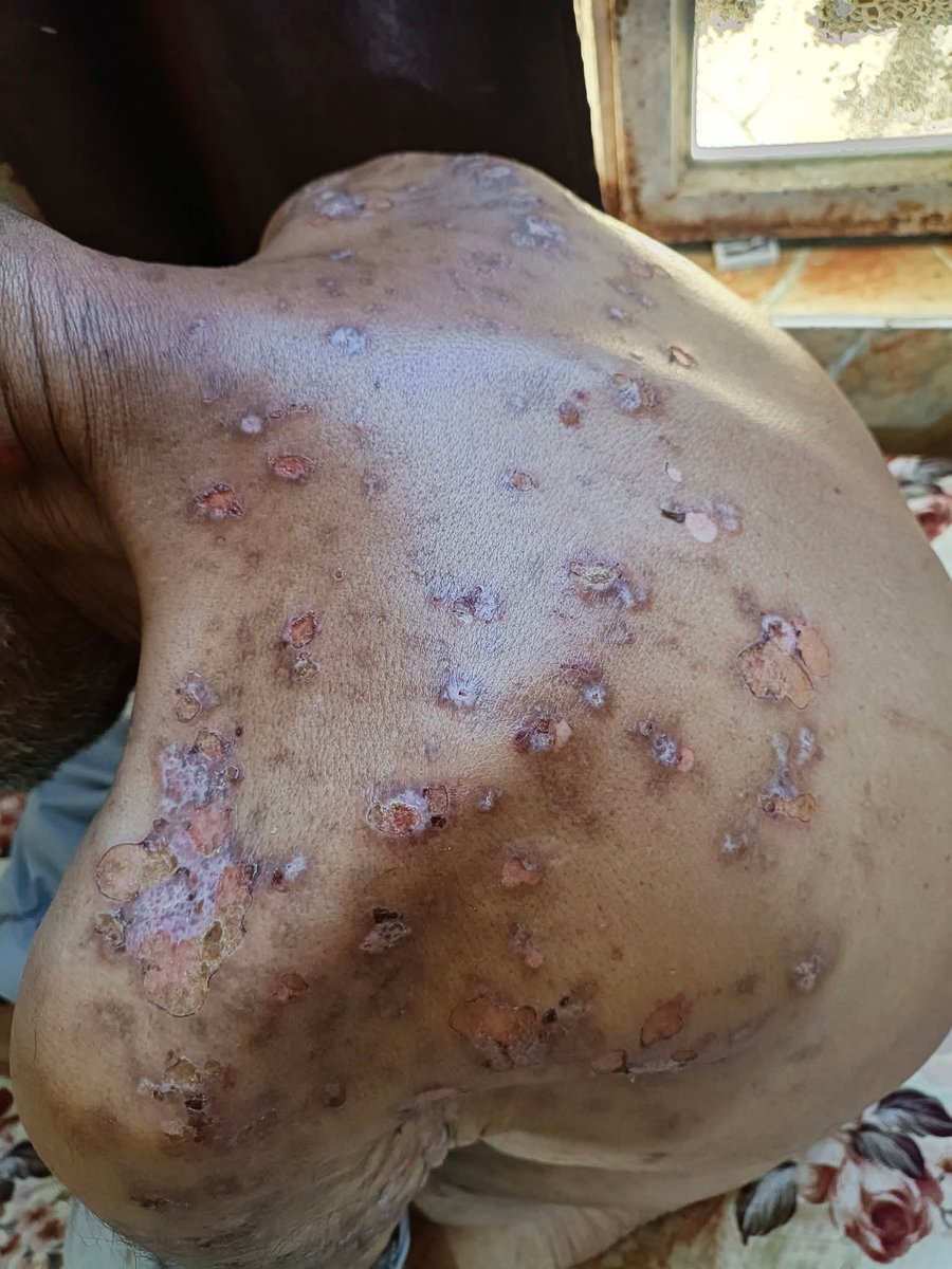 hmd_mhmd9832's tweet photo. Breaking news💔😭
Please help my father! He has scabies. It has spread all over his body, probably from tent insects or mosquitoes. Please help me get him treatment.😭💔 https://t.co/nqNLoIk8Tz