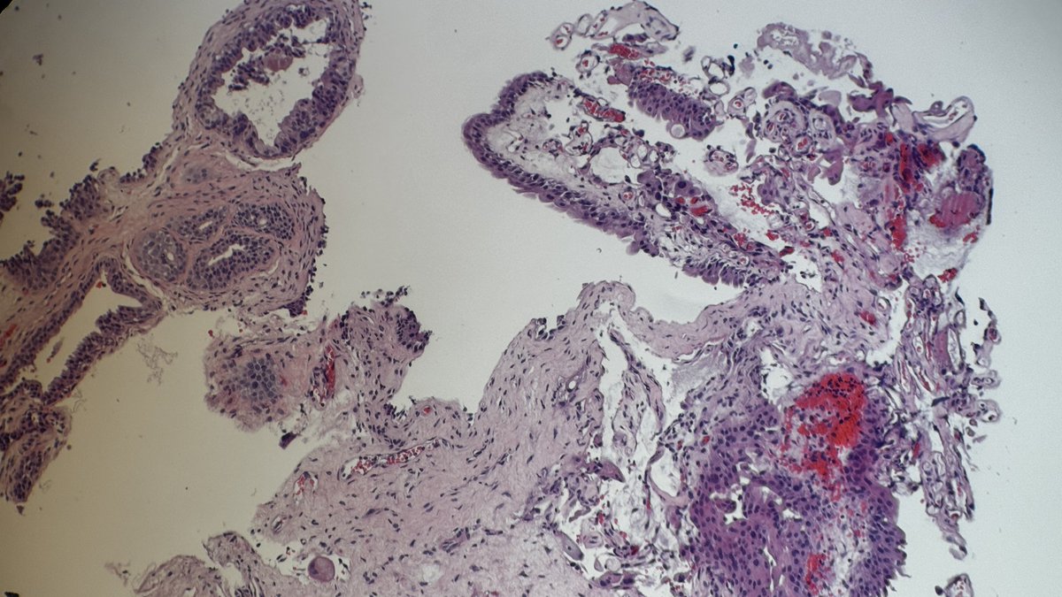 Andresangel3's tweet photo. #GUpathology #Urologicpathology #Genitourinarypathology #Surgicalpathology #Pathology 83 year man, polypoid formation in prostatic urethra, found after ureteral stone removal. Is this a Polypoid Papillary Chronic Urethritis. Your diagnosis….. https://t.co/U9AiNW70o9
