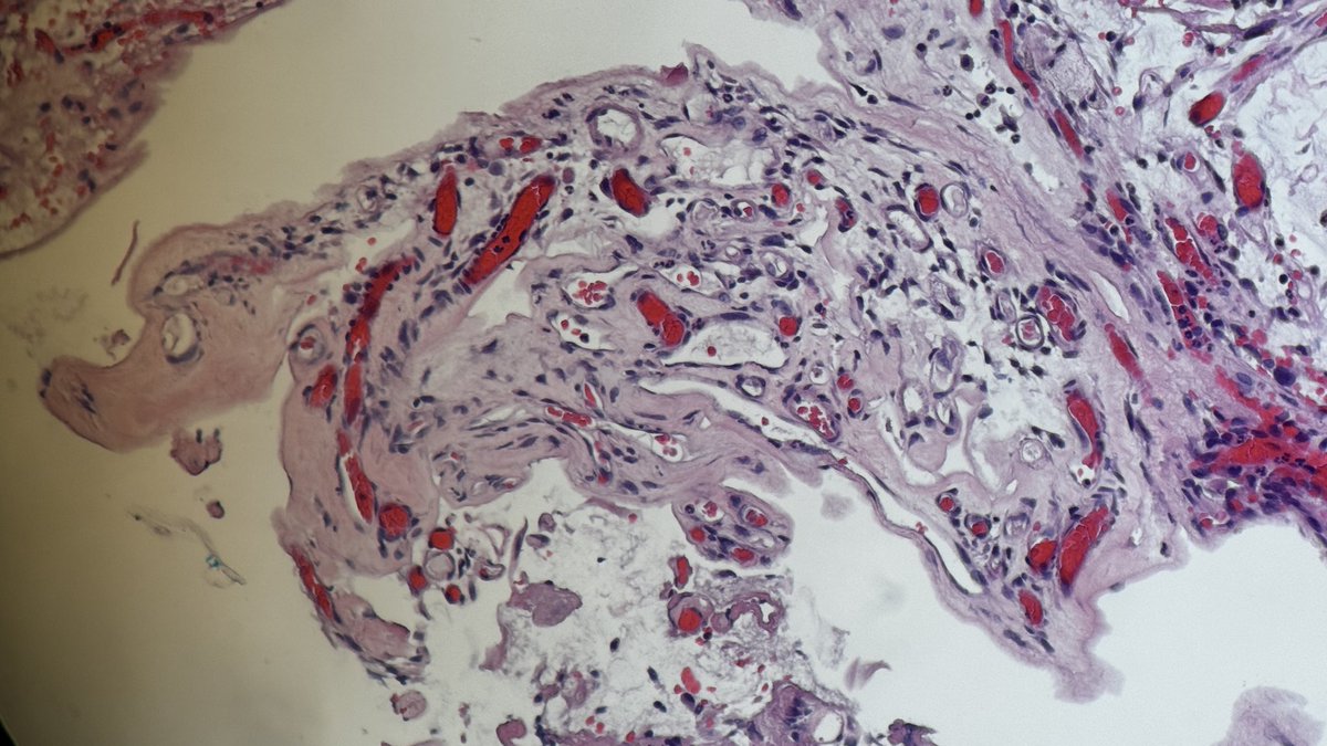 Andresangel3's tweet photo. #GUpathology #Urologicpathology #Genitourinarypathology #Surgicalpathology #Pathology 83 year man, polypoid formation in prostatic urethra, found after ureteral stone removal. Is this a Polypoid Papillary Chronic Urethritis. Your diagnosis….. https://t.co/U9AiNW70o9