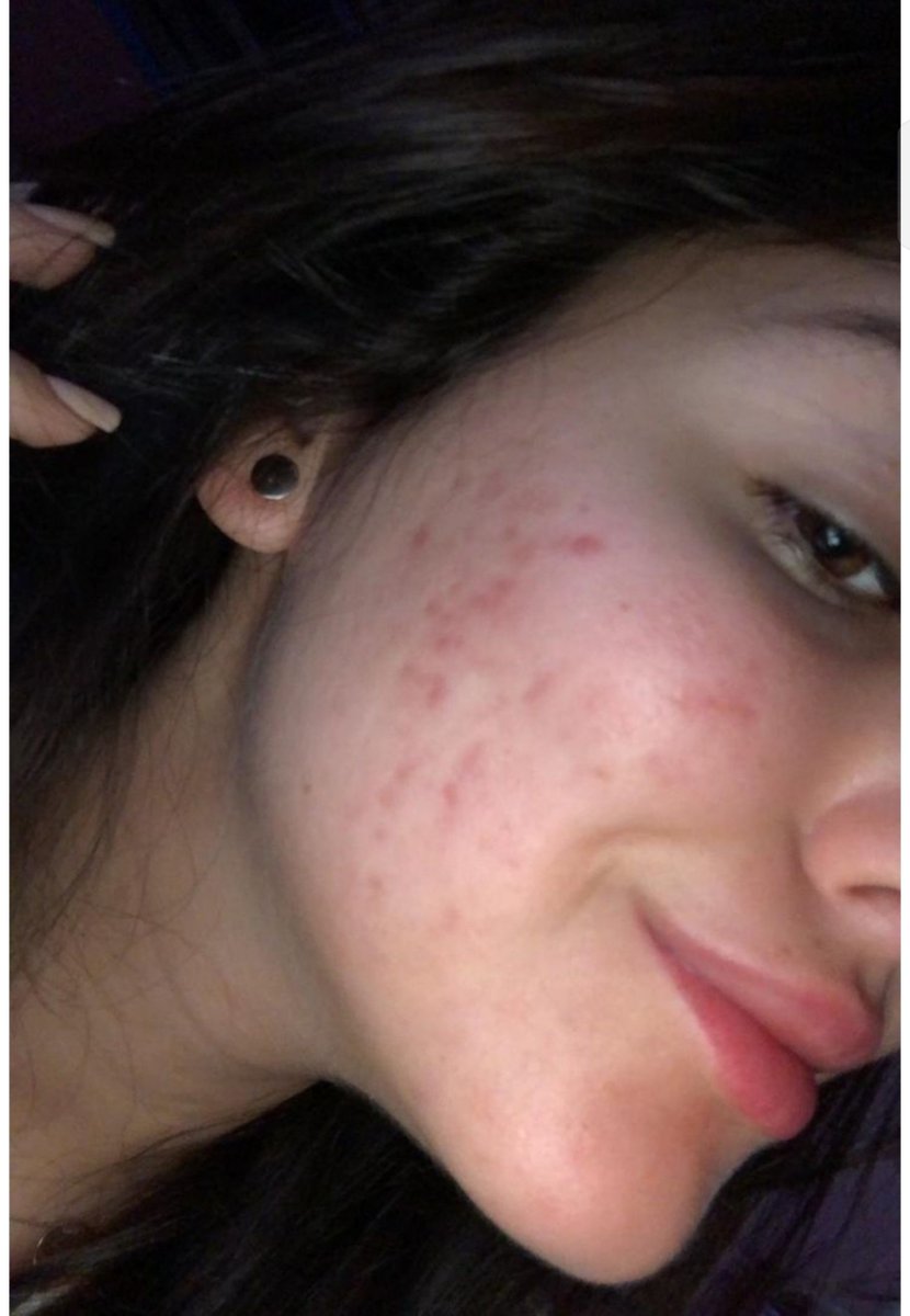 _HiHuma's tweet photo. Iss pimples ka elaj batao koi? https://t.co/LuduE61rxD
