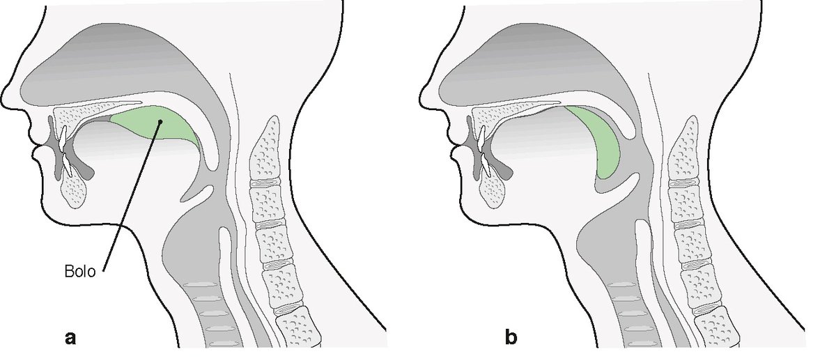 PasionAnatomia's tweet photo. Tragar (deglutir) es un acto complejo que se puede dividir en tres fases:
📌Fase oral (1): se fragmentan y digieren los alimentos (verde) en la boca de forma voluntaria (a). La #lengua se comprime contra las encías y empuja el bolo alimentario hacia el istmo de las #fauces (b). https://t.co/DluE9huKoJ