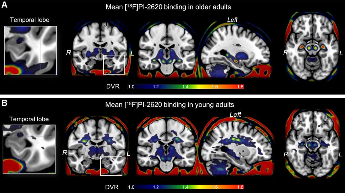 JournalofNucMed's tweet photo. Temporal ¹⁸F-PI-2620 binding is associated with genetic Alzheimer’s disease risk, plasma p-tau₂₁₇, female sex, and episodic memory deficits in cognitively unimpaired. older adults. https://t.co/DqWs3zkrAX
#NuclearMedicine #PETscan https://t.co/SMUpkONYvj