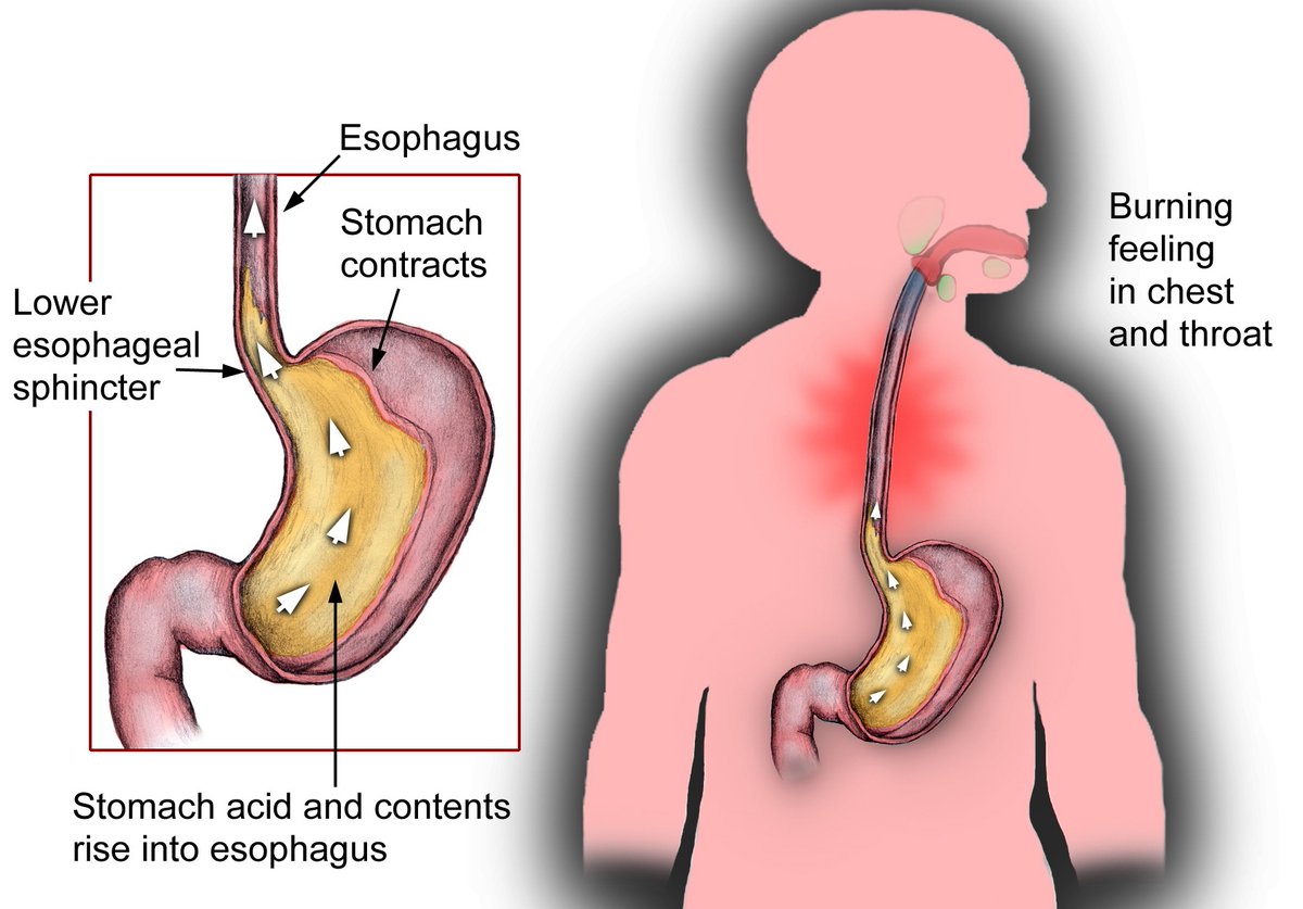 VivaHealthyLife's tweet photo. Best Homeopathic Remedies for Acid Reflux
Homeopathic remedies for acid reflux can also provide relief without any adverse effects. Like other alternative medicines, homeopathy concentrates on... Read more: https://t.co/qL7NQWHgtM #gerd #acidreflux #acidity #homeopathy https://t.co/fQEI1XRHpp