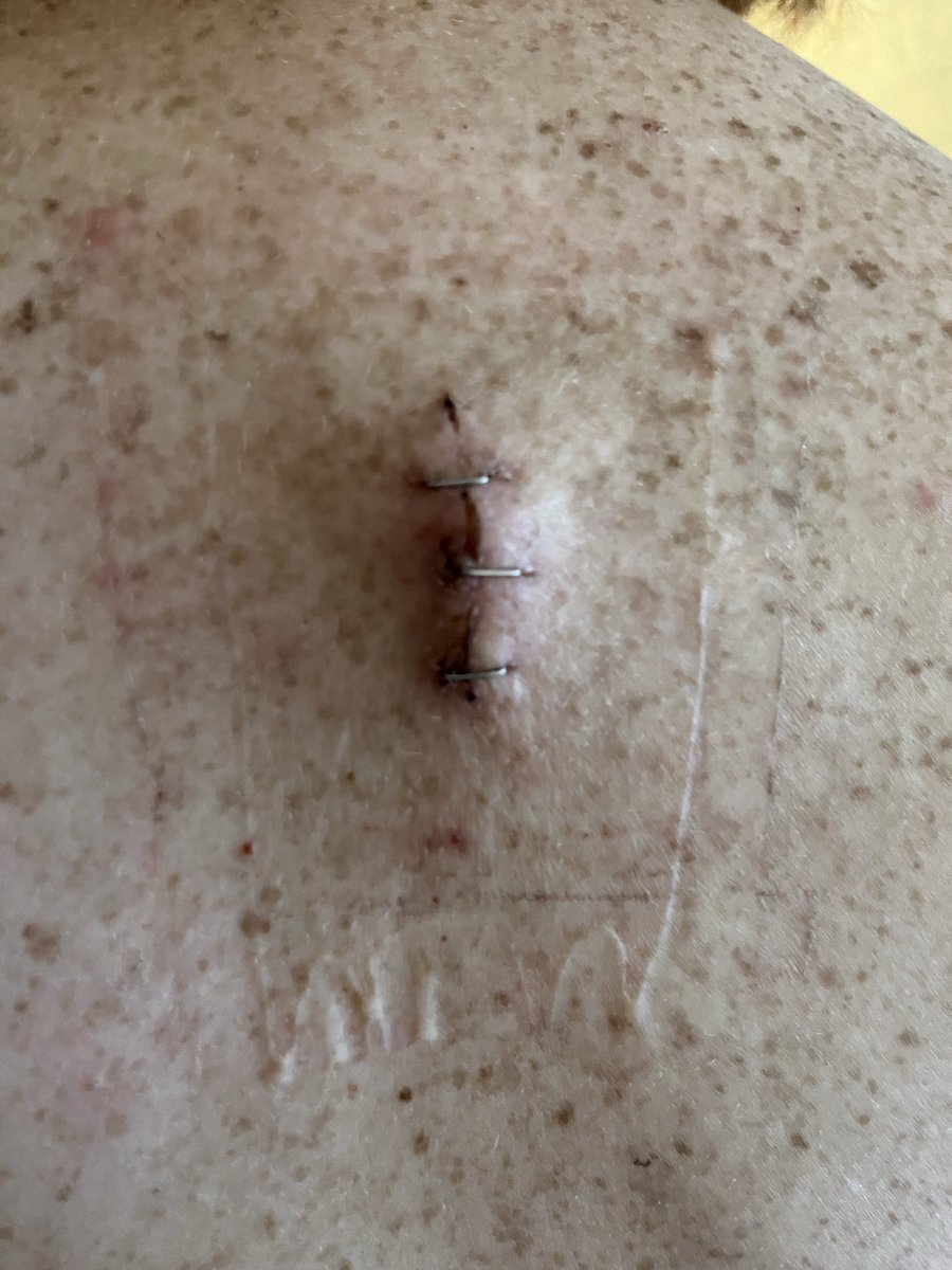Kaila2214's tweet photo. 13 days after spinal cord surgery #surgery #update https://t.co/gIVOb71d5G