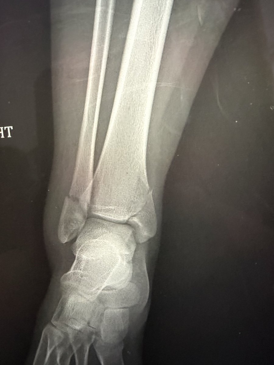 KrisChenardMD's tweet photo. @sportsdoc2016 @InvictaOrtho @orthotraumamd @traumaticum Can compress it mega https://t.co/MZmRschl9g