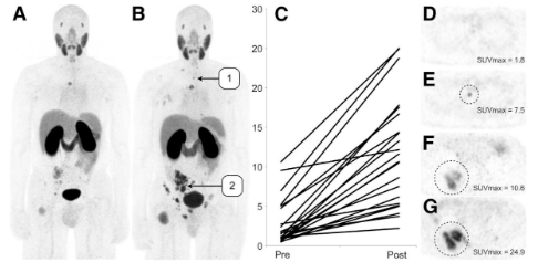 urotoday's tweet photo. Should PSMA PET be used for treatment response assessment today?
Dr. Steven Rowe @UTSWMedCenter at #USPCC26 says NOT YET.
Key cautions:
â ď¸ PSMA expression is dynamically regulated by the androgen axisâADT/ARPIs can alter uptake independent of true tumor burden (flare, downregulation)
â ď¸ Quantitative metrics (SUVmax/mean/total, volume) show meaningful testâretest variability; lesion identification/segmentation remains inconsistent
â ď¸ RECIP is promising for radioligand therapy but needs broader validation; AI-assisted standardization is still evolving
Bottom line: PSMA PET has clear staging value, but biologic modulation, reproducibility issues, and immature criteria mean it has no routine role for response assessment yetâfocus on understanding PSMA kinetics and improving AI-based quantification.
Written coverage by @zklaassen_md @GACancerCenter on UroToday > https://t.co/RBonFyL2QY @PCFnews