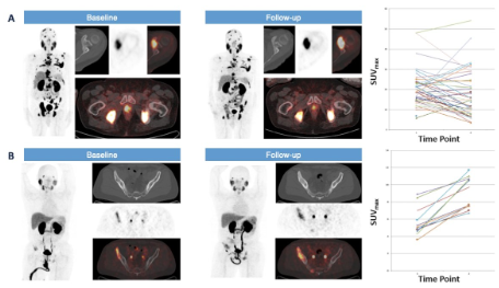 urotoday's tweet photo. Should PSMA PET be used for treatment response assessment today?
Dr. Steven Rowe @UTSWMedCenter at #USPCC26 says NOT YET.
Key cautions:
â ď¸ PSMA expression is dynamically regulated by the androgen axisâADT/ARPIs can alter uptake independent of true tumor burden (flare, downregulation)
â ď¸ Quantitative metrics (SUVmax/mean/total, volume) show meaningful testâretest variability; lesion identification/segmentation remains inconsistent
â ď¸ RECIP is promising for radioligand therapy but needs broader validation; AI-assisted standardization is still evolving
Bottom line: PSMA PET has clear staging value, but biologic modulation, reproducibility issues, and immature criteria mean it has no routine role for response assessment yetâfocus on understanding PSMA kinetics and improving AI-based quantification.
Written coverage by @zklaassen_md @GACancerCenter on UroToday > https://t.co/RBonFyL2QY @PCFnews