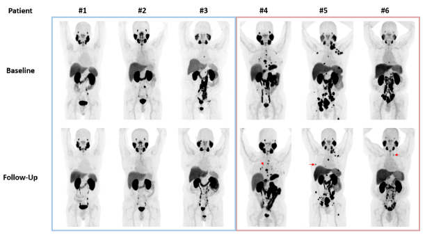 urotoday's tweet photo. Should PSMA PET be used for treatment response assessment today?
Dr. Steven Rowe @UTSWMedCenter at #USPCC26 says NOT YET.
Key cautions:
â ď¸ PSMA expression is dynamically regulated by the androgen axisâADT/ARPIs can alter uptake independent of true tumor burden (flare, downregulation)
â ď¸ Quantitative metrics (SUVmax/mean/total, volume) show meaningful testâretest variability; lesion identification/segmentation remains inconsistent
â ď¸ RECIP is promising for radioligand therapy but needs broader validation; AI-assisted standardization is still evolving
Bottom line: PSMA PET has clear staging value, but biologic modulation, reproducibility issues, and immature criteria mean it has no routine role for response assessment yetâfocus on understanding PSMA kinetics and improving AI-based quantification.
Written coverage by @zklaassen_md @GACancerCenter on UroToday > https://t.co/RBonFyL2QY @PCFnews
