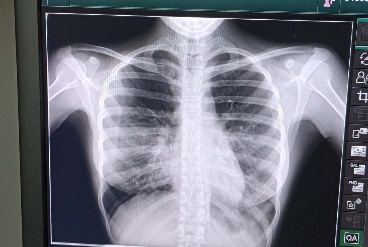 Vikoonn's tweet photo. Tengo una fuerte infección respiratoria y me mandaron tratamiento intravenoso por 7 días y dos antibióticos + dieta líquida y reposo

(Reposo que no podré cumplir obviamente 😿) https://t.co/MjhuIG3DbK