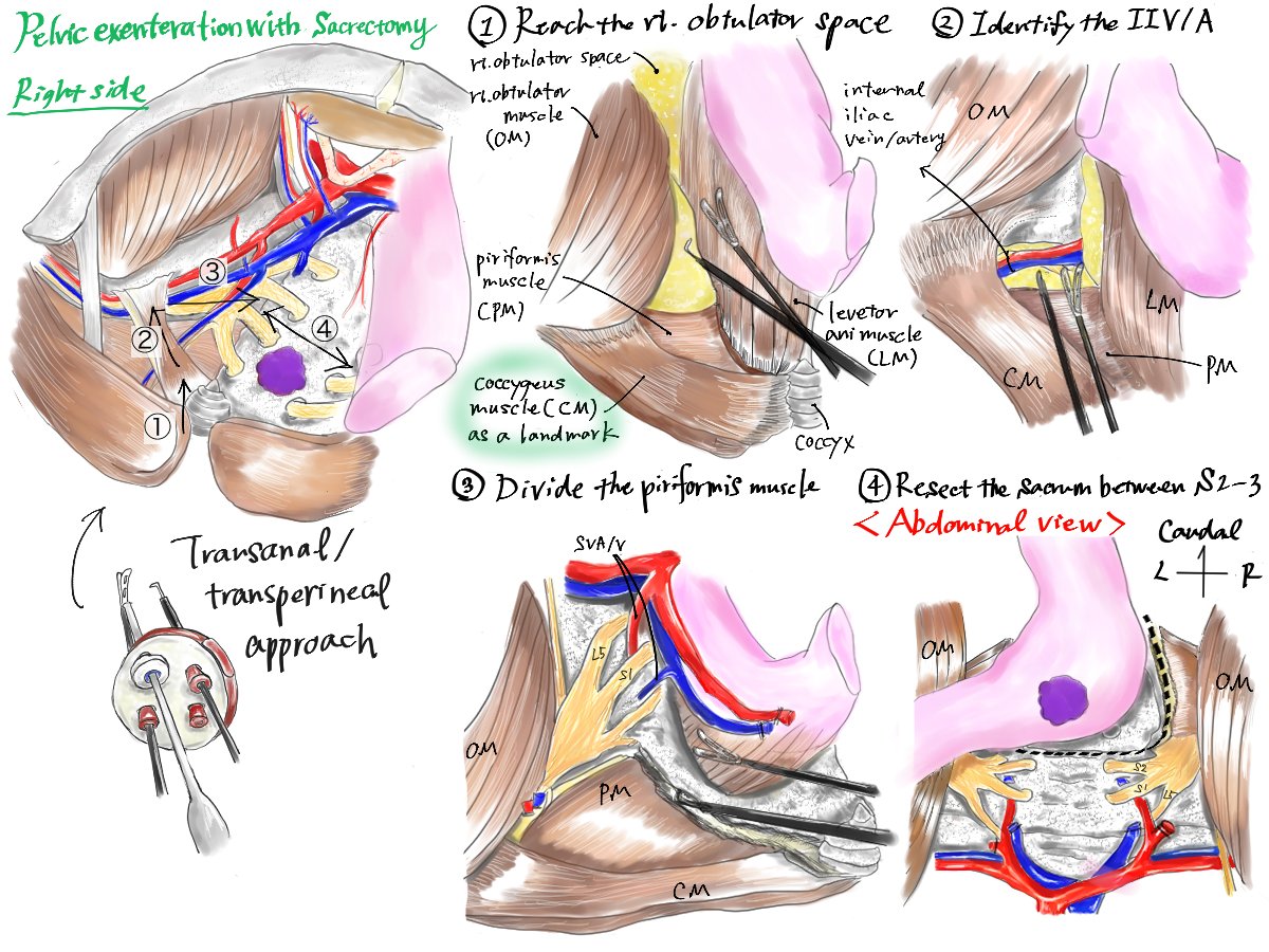 jses_eng's tweet photo. 🎨 2nd JSES Illust Contest #3
📌 Ta/Tp pelvic exenteration with sacrectomy
🖊 yukiko nonaka
#JSESイラストコンテスト #JSES_illustration_contest https://t.co/KL5jSDS37P