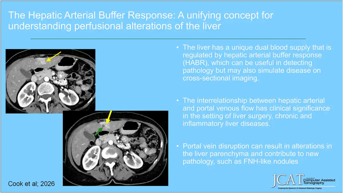 JCATonline's tweet photo. "New @JCATonline
'The Hepatic Arterial Buffer Response: A Unifying Concept for Understanding Perfusional Alterations of the Liver'
Jul/Aug 2026 https://t.co/rcf2kbw2Sg Au: Emily Cook et al.
#liver #CT https://t.co/bGLUWLLRrX