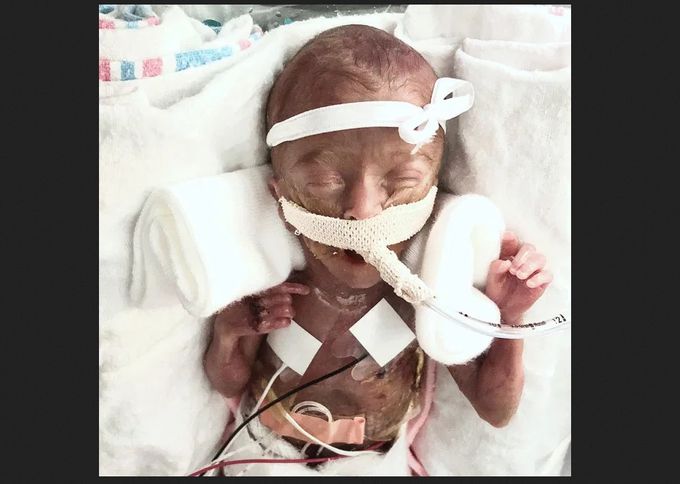 LifeNewsHQ's tweet photo. This is a premature baby at 22 weeks.

Where's the ball of tissue? https://t.co/Aup4uCLLwq