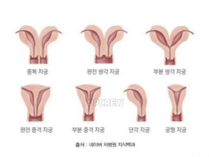 jutingstar9999's tweet photo. 의외로 생리통 강도가 사람마다 다른 이유래 ㄷㄷ
.
>우리가 흔하게 알고있는 자궁 모양은 첫짤 사진이지만
자궁 모양은 저거 하나가 아니었슨;;
>두번째 짤 사진처럼 다양한 모양이 있음
>예를들어 자궁이 둘로 나뉘거나 한쪽만 있거나 새싹 모양등 다양한 형태...
>자궁기형이라고 부르는데 어감이 좀 이상하지만 의외로 흔하다고!
>그래서 유난히 생리통이 심한 사람은 산부인과 진료 권장