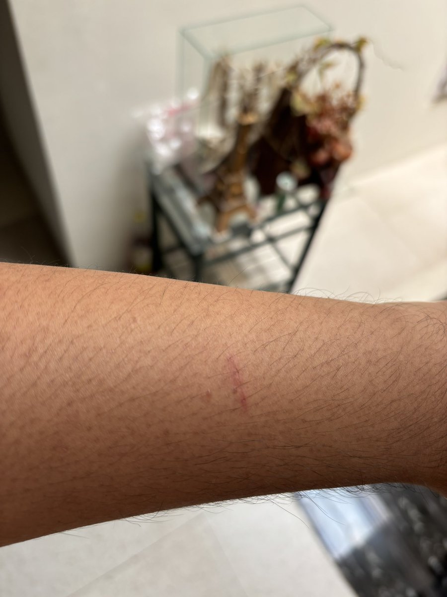 phnmnlanomaly's tweet photo. Aneh bgt udah 2 hari bangun-bangun tbtb ada luka kecil, tapi ga sakit sih https://t.co/UYwDMWYB2h