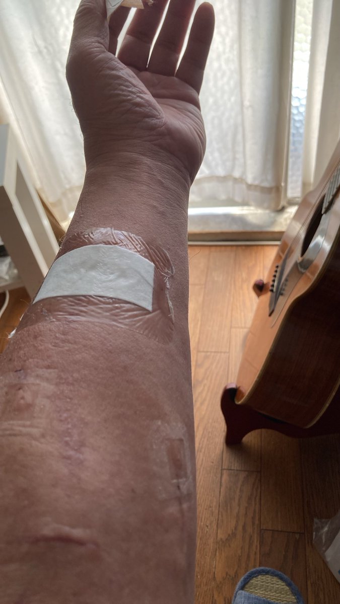 kaz6thlife's tweet photo. ãMy #dialysis #simptom's memoã
ð¥ðð©ââïžð©žðð©»â¿ïžðªð¥Œð¡ïž
#人工è¡ç®¡ ã¯ãèœã¡çããŠããŸãã https://t.co/jyV7GvrKB6