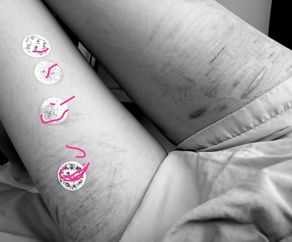 2_e2715194's tweet photo. Pain reduction
Putting sticky stickers on my scars and peel them https://t.co/gurXJ10lw7