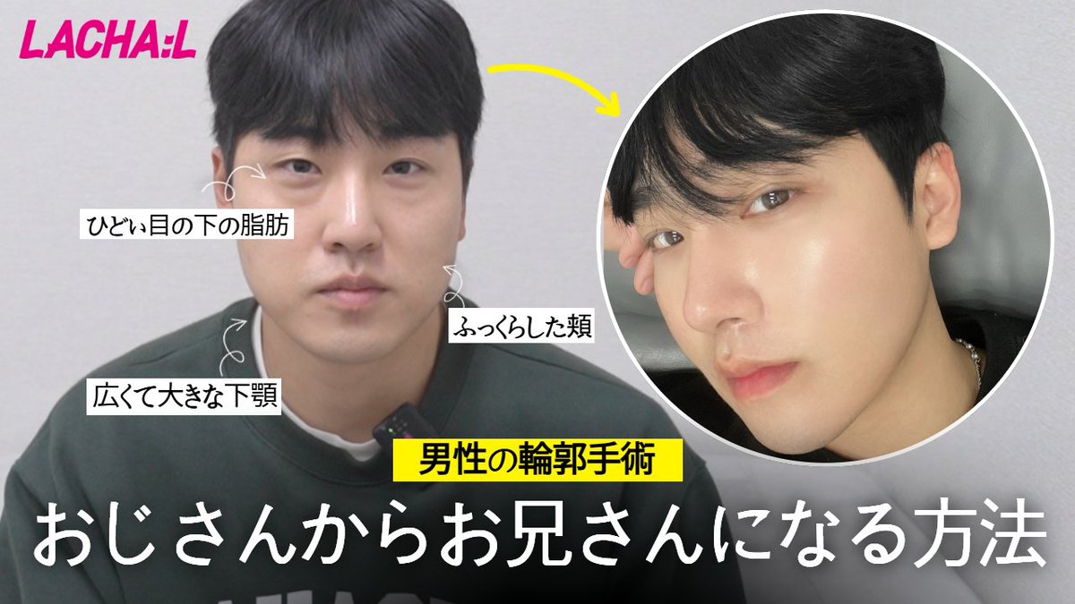 Lachal_JP's tweet photo. この方は輪郭手術を通じてストレスを受けていた目、頬の脂肪、エラをなくし、新しい人生を送っていると聞きました！
今の人生が本当に楽しいと言っています！

＃美容外科
＃韓国整形
＃目整形
＃輪郭手術
＃Lachal

申し込みはこちらえ！
🔻🔻🔻
https://t.co/ge1ugwXO1Z https://t.co/esJ6f28zrw