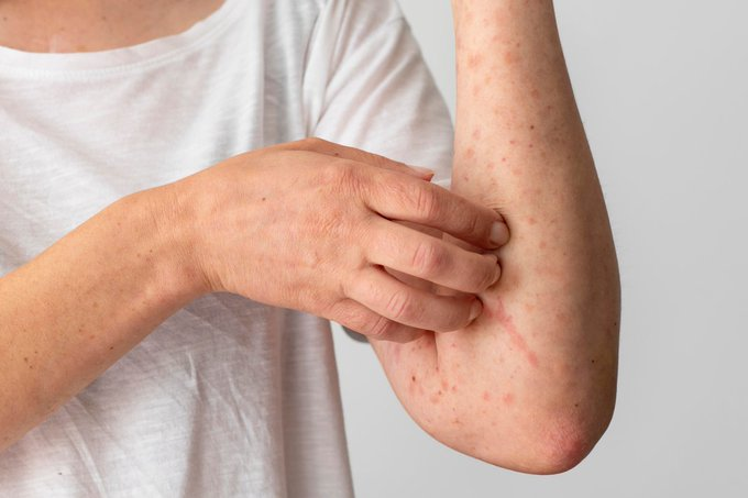 pelinnaltm's tweet photo. Yeni bir araştırma, 500 yıllık mumyalardaki antik DNA izleri sayesinde çiçek hastalığının Avrupa'dan geçtiğini gösteriyor.

Caner Çaykara 7 Ağustos Kuşadası Belediyesi'ne #FCHvBJK #GenelAfŞart #KobiBüyürseBursaBüyür #altın #CITAS #bofa #endeks https://t.co/B2kr0MBq7S