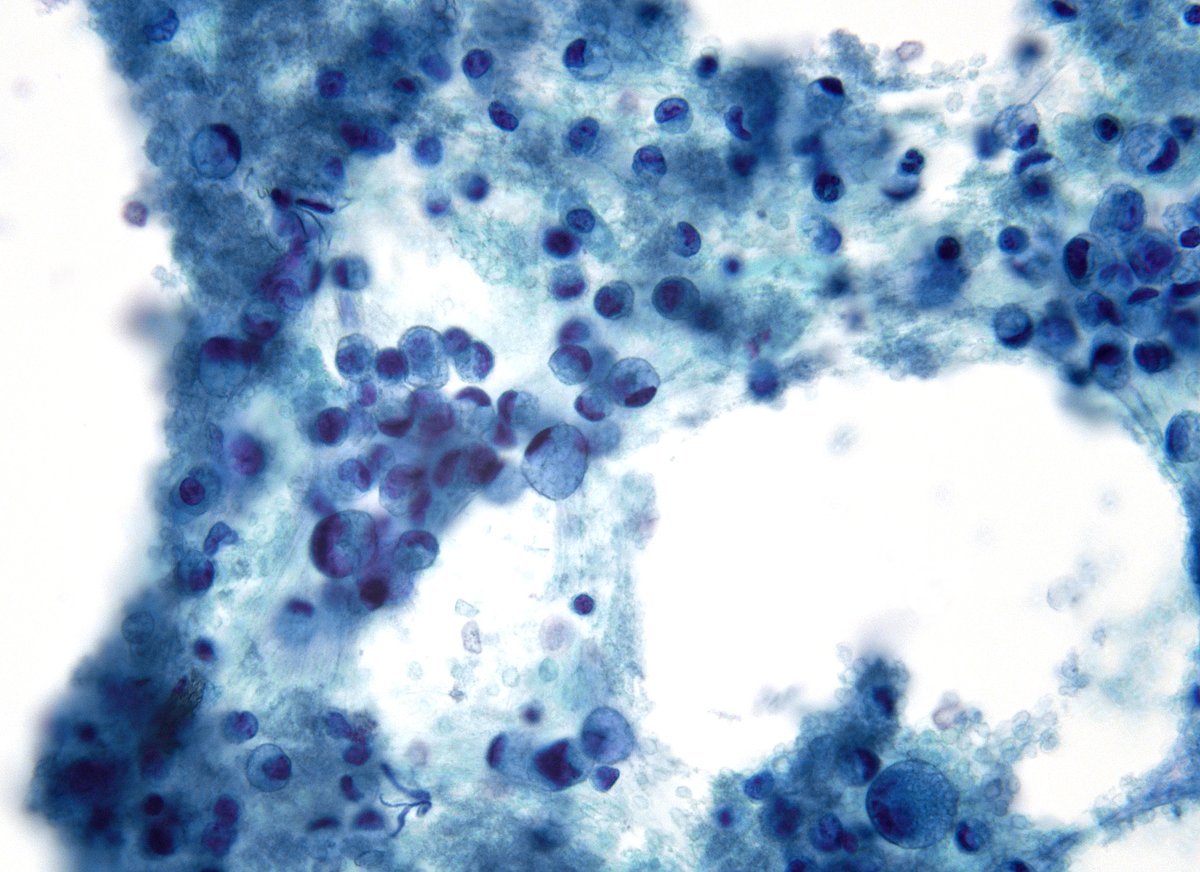 sza_jhcyto's tweet photo. "In cytopathology, one signet ring cell may whisper, but a cluster always shouts malignancy." Hepatic hilar node with metastatic colonic adenocarcinoma, signet ring cell type. (FNA, Smear and Cell block). https://t.co/AzxmtbxJ3Q