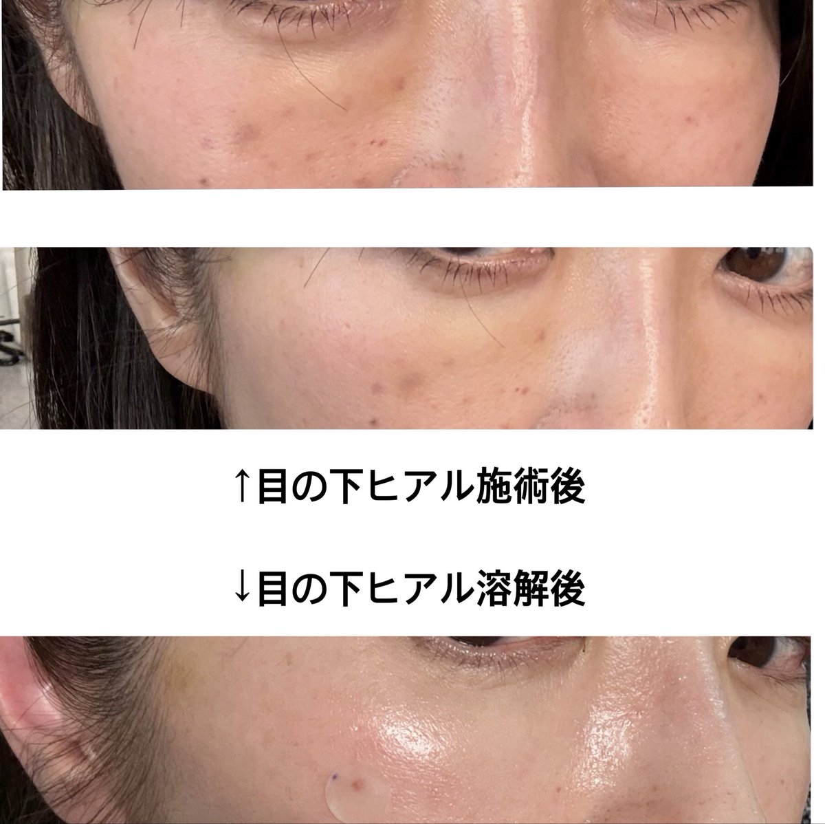 meimomo10's tweet photo. 最近の失敗した施術は目の下ヒアル。
目の下の窪みにヒアルおすすめされて注入したら、クマみたいな白い膨らみできた。柔らかい製剤を浅い層に入れたのが原因みたいで溶かしたらすっきり。

骨膜上の深い層にしっかり入れないとこうなるらしい🫩安易に入れてはダメなんだな〜って反省、、 https://t.co/mMigSC62sk