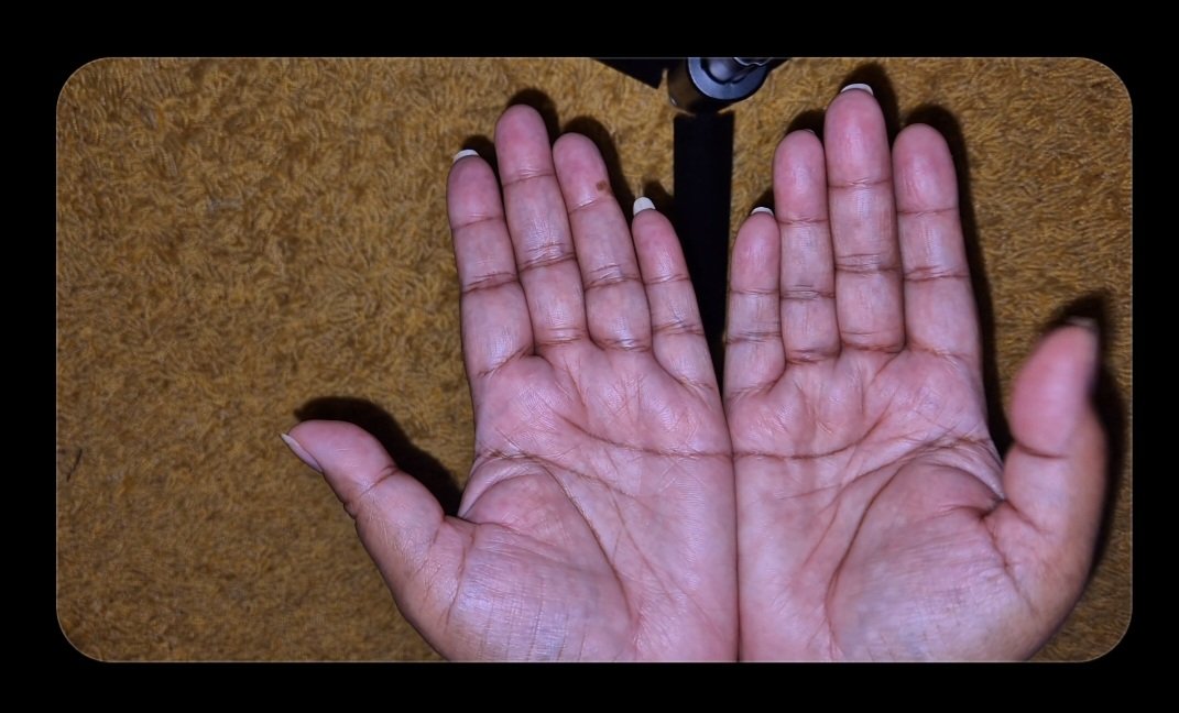 SuchitraBisoen's tweet photo. 5G / Cellphone / PC Posts

Video July 2020
These are my hands after 3 months of constantly holding my cell phone (to stay up to date on all the Corona Bullshit). The hand I used to hold my phone has become completely crooked, and I’ve been experiencing extreme pain in my joints ever since. 

Just BEFORE 5G was rolled out, I contacted my provider, Vodafone, by phone because there were so many negative stories circulating. When I asked whether 5G could have Negative effects on the body and your health, the answer was: “We assume that 5G will not have negative effects on people’s bodies and health, BUT we we also CANNOT DENY that it MIGHT have negative effects.” 

I Don't use WIFI, most of the times when I use my Cellphone I place it on a pillow or Cellphone holder, I'm using Eyedrops on a daily basis because of Dry Eye Syndrom that started.....after using a Cellphone (I will share more about this later). 

Just Be Aware, when using your cellphone your head is always downward so eventually it Will cause Neck pain and your breathing gets worse because when you keep your head down all the time, it restricts your breathing.