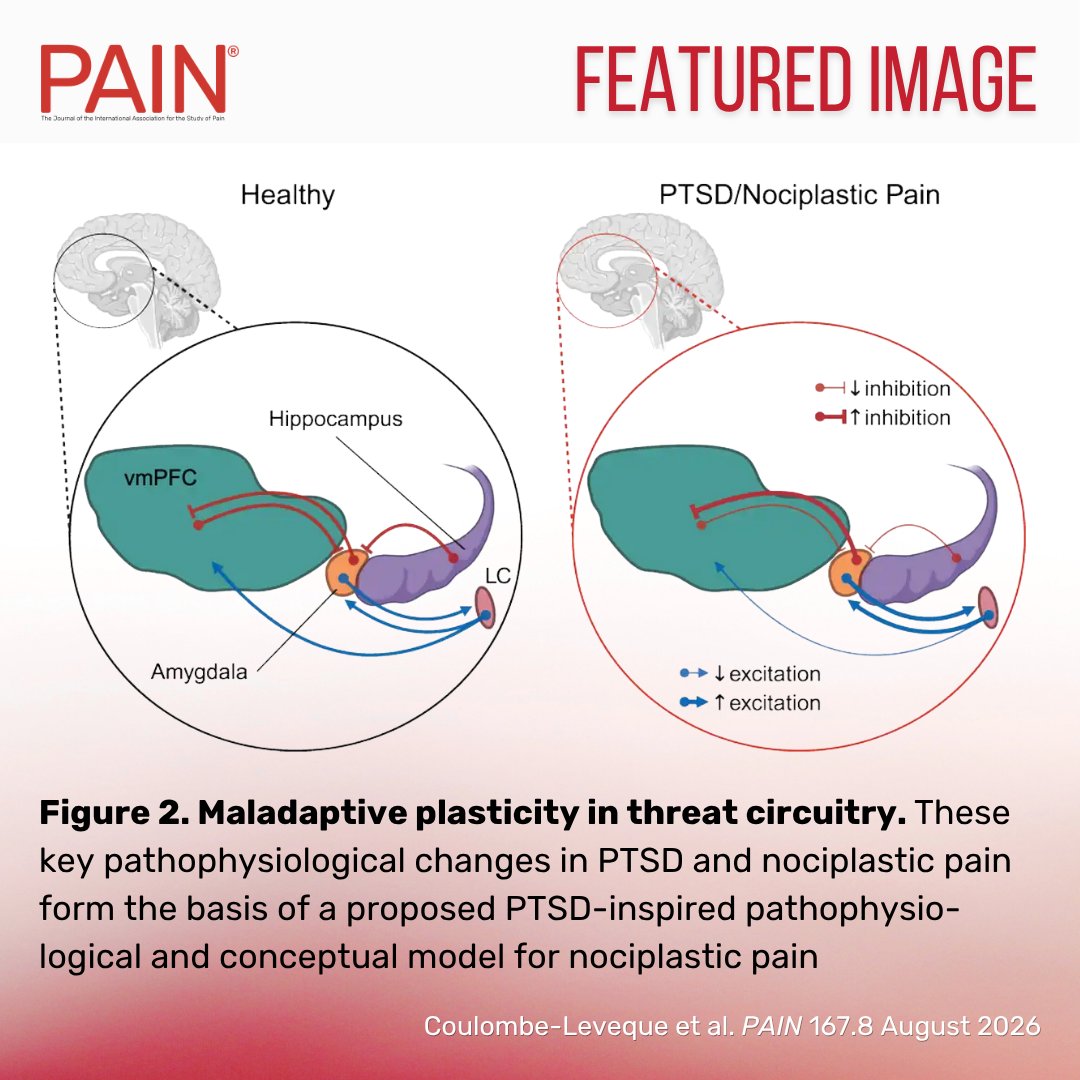 PAINthejournal's tweet photo. In this week’s #PAIN Featured Image, Coulombe-Leveque et al. depict key pathophysiological changes in PTSD and nociplastic pain that form the basis of a proposed PTSD-inspired pathophysiological and conceptual model for nociplastic pain. Learn more at https://t.co/pIn3Si5jXy https://t.co/bzIsEkXzTX