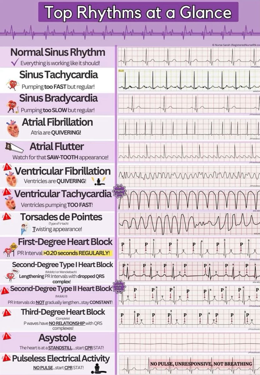 OGdukeneurosurg's tweet photo. Top heart rhythms https://t.co/jthbdEYnUs