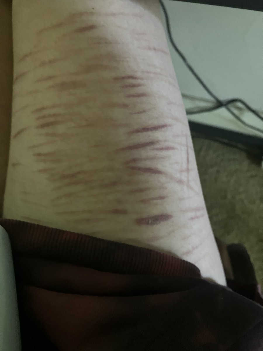 cherry_mikamika's tweet photo. Scar check for being nearly 50 days clean 🫩 #slitwt https://t.co/IbGYlPQKiG