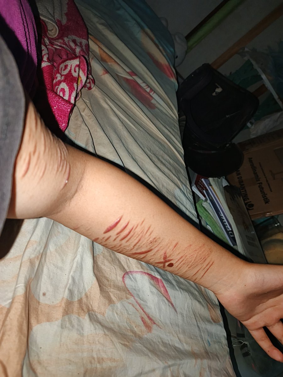 dist0rtednorms's tweet photo. my guidance counselors keeps telling me to cover these up

fake all, this is sfx make up made for movie props only https://t.co/moutoIzeGY