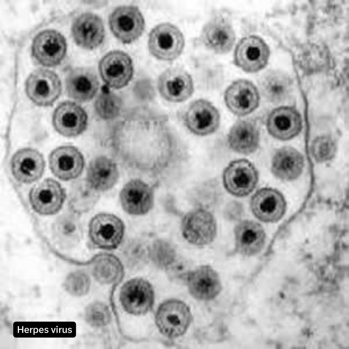 docakx's tweet photo. A modified herpes simplex virus that can kill cancer cells has been approved by the FDA.

On August 6, 2026, the FDA approved a new treatment called Tudriqev. It is a specially changed virus( oncolytic virus), made from the herpes virus, that doctors inject straight into the tumour. The virus helps kill cancer cells. It is given together with another medicine called nivolumab.

It is specifically approved for unresectable advanced cutaneous melanoma in adults whose disease has progressed after previous treatment with a PD-1 blocking antibody (such as pembrolizumab or nivolumab alone).