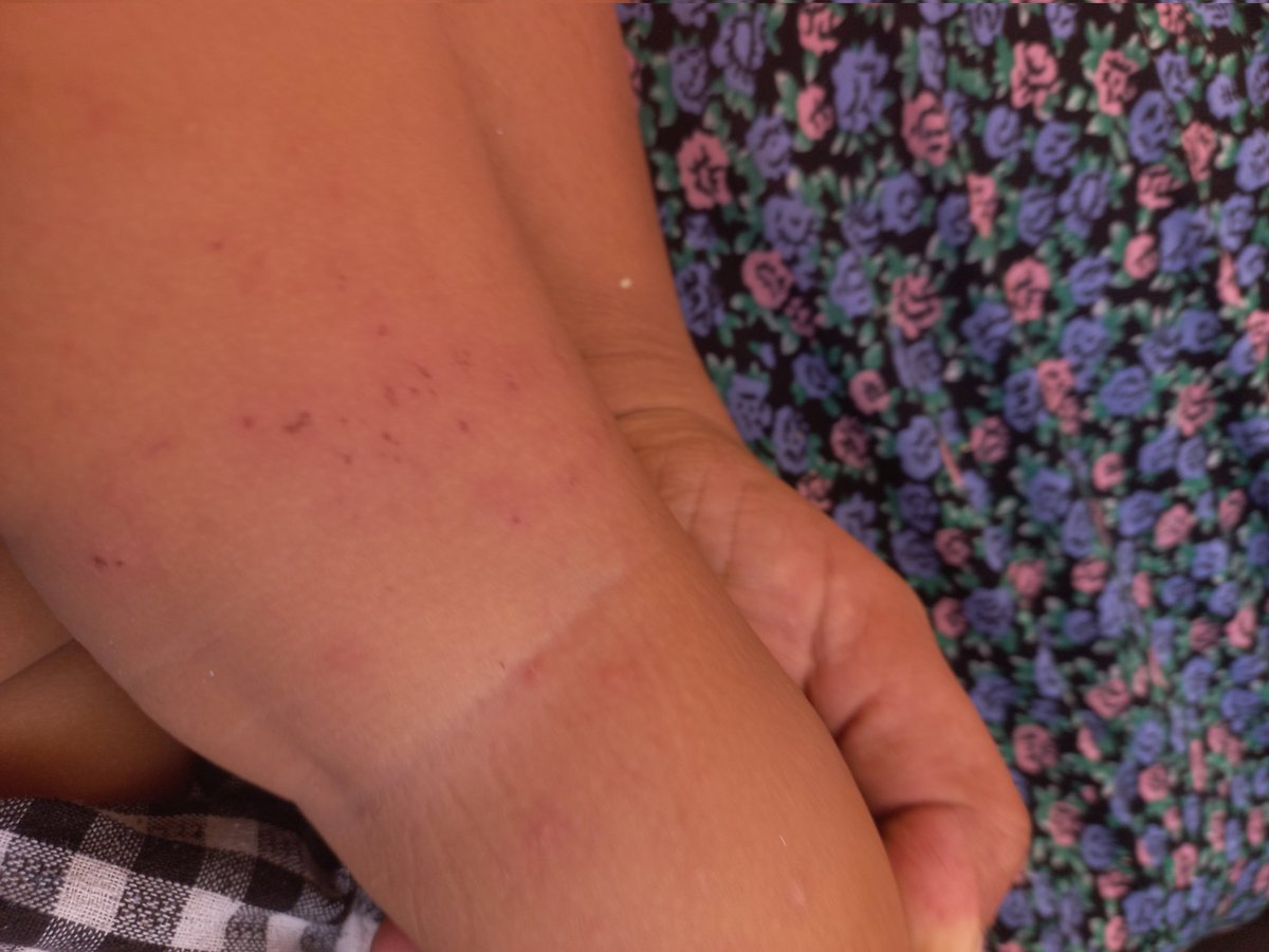 Laiesea's tweet photo. My little Maryam cries and scratches her skin all day long
The insect bites leave her uncomfortable and restless, and it breaks my heart to see her suffer without relief
No child should have to spend her days fighting itching and discomfort instead of simply playing and smiling https://t.co/mqFylnA7Qv