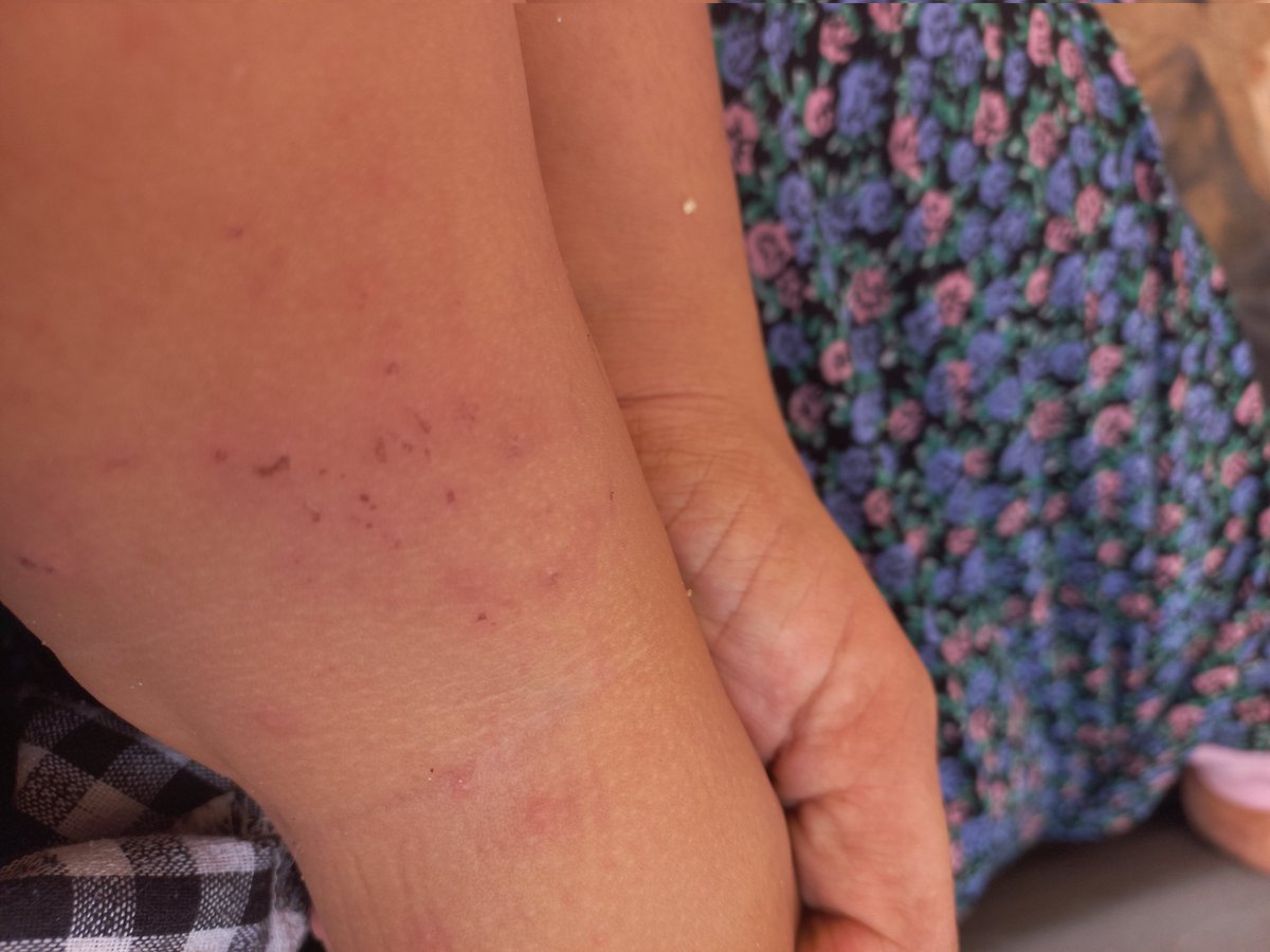 Laiesea's tweet photo. My little Maryam cries and scratches her skin all day long
The insect bites leave her uncomfortable and restless, and it breaks my heart to see her suffer without relief
No child should have to spend her days fighting itching and discomfort instead of simply playing and smiling https://t.co/mqFylnA7Qv