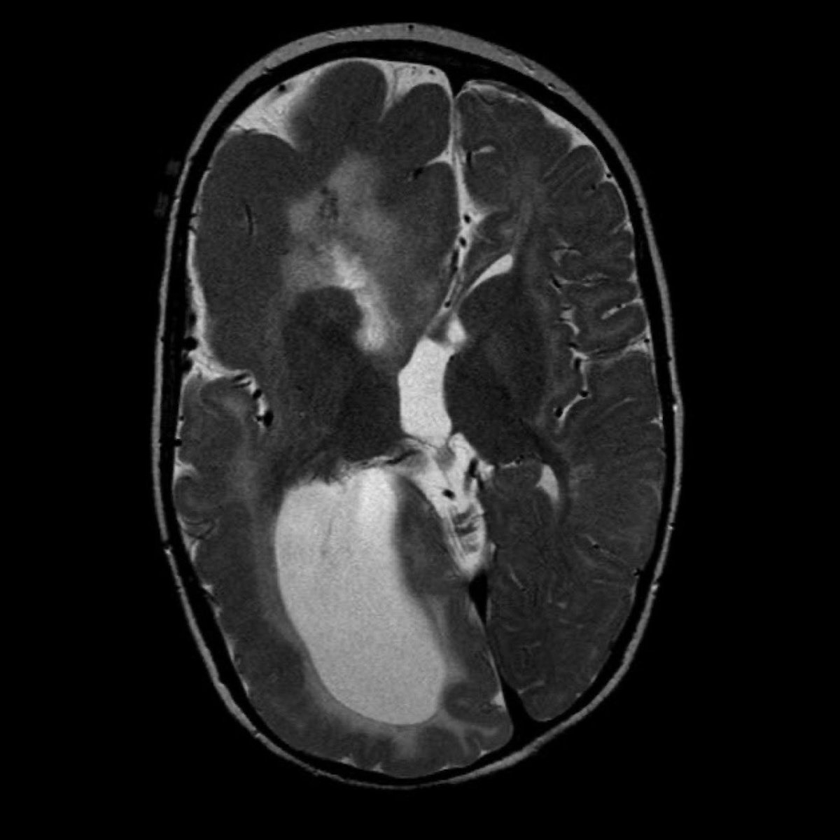 DrAyubaD's tweet photo. Infant with refractory seizure.

What is your diagnosis? https://t.co/cwWJ23Y7p1