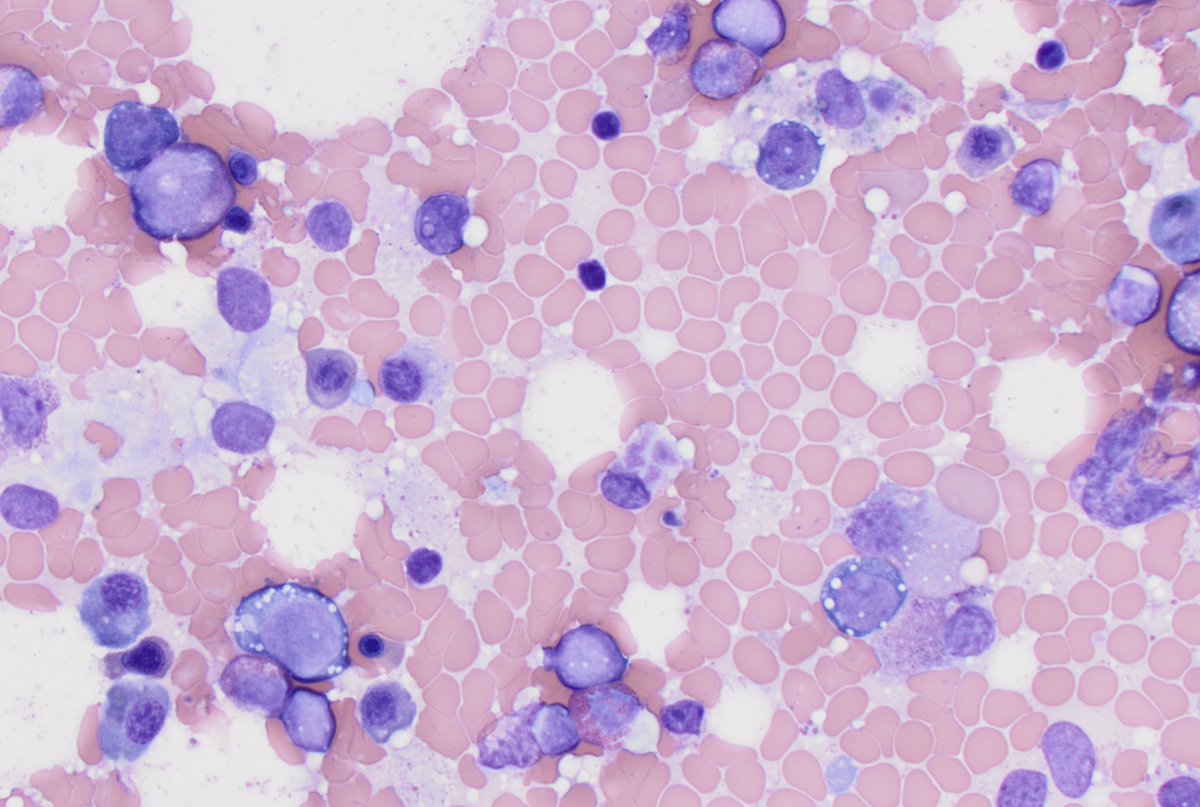 CUHemepath's tweet photo. Sharing another #hemepath #pathboards beauty to start off Friday. Older patient with anemia. What's your ddx? https://t.co/H6u49YhvLe