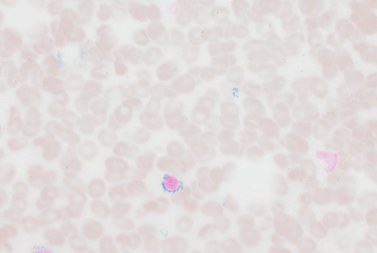 CUHemepath's tweet photo. Sharing another #hemepath #pathboards beauty to start off Friday. Older patient with anemia. What's your ddx? https://t.co/H6u49YhvLe