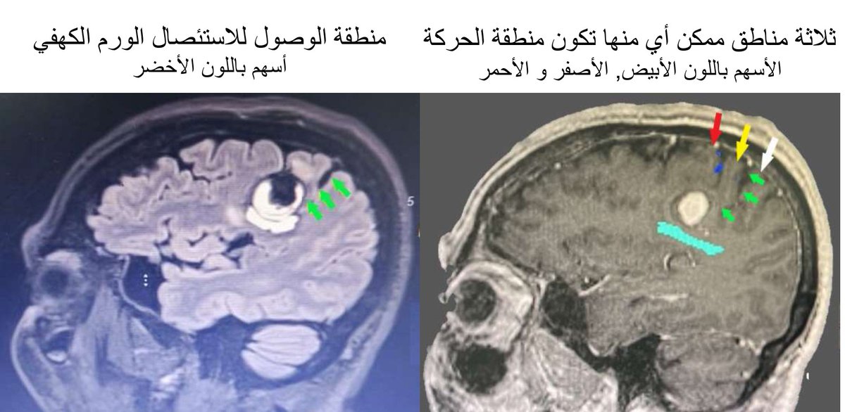 DrFaisalTSayer1's tweet photo. قيل: إذا كنت تنتظر الظروف المثالية، فلن تصبح جراحاً أبداً.
----------------------------------------------------------
مريض في نهاية العقد السادس وبدون أي تاريخ مرضي سابق.
شعر بصعوبة في التوازن/المشي وضعف واضح باليد اليسرى.
وبيّن الرنين وجود نزيف+ ورم وعائي كهفي (cavernoma).
وواضح وجوده في منطقة حرجة جدا فيما يخص الحركة والنطق.
----------------------------------------------------------
ونلجأ في تلك الحالة لتحريض قشرة الدماغ لتحديد منطقة الحركة
ورغم إستعمالها سابقا في مايزيد على 120 حالة منذ عام 2014
إلا أن هذه الحالة الأولى التي لم تسعفنا تلك التقنية خلال الجراحة
----------------------------------------------------------
وقررنا الإستمرار في العملية بإعتماد النقاط البسيطة  التالية:
1. إستعمال الخريطة التشريحية مع جهاز الملاحة الجراحي (Omega sign vs Central sulcus).
2. الدخول في ثلمات الدماغ بين تلافيف المخ (The trans-sulcal approach).
3. الدخول من اقصى جزء خلفي من النزيف (إحتمال قربه من منطقة الحركة أقل).
4. إستعمال تقنية الجهد المُستثار الحركي بشكل متكرر أثناء الإستئصال.
----------------------------------------------------------وتم الإستئصال والمريض بفضل الله بخير ومتوقع خروجه من المستشفى خلال يومين
.

الأحداث غير المتوقعة أثناء الجراحة تتطلب: 
1. تركيزاً هادئاً.
2. تعاملاً دقيقاً مع الأنسجة.
3. مرونة ذهنية.