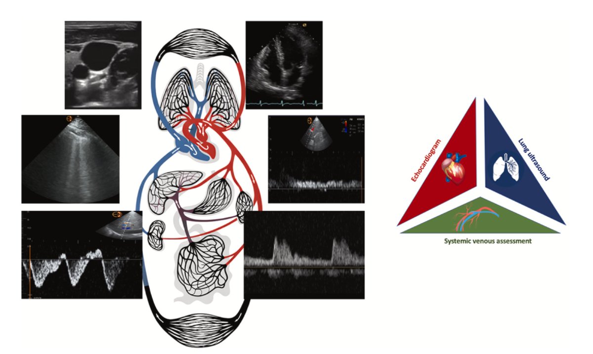IM_Crit_'s tweet photo. Nice review article by @Aboumarie (kudos!) examining the evolution, physiological principles, and clinical applications of point-of-care ultrasound (POCUS) and Critical Care Echocardiography (CCE)
 
Some take-home points:
* POCUS has expanded from simple bedside "rule-in/rule-out" exam into a comprehensive diagnostic approach
** The "POCUS Pyramid": Effective hemodynamic evaluation relies on integrating three key pillars rather than evaluating an organ in isolation: 
echocardiogram + lung ultrasound + systemic venous assessment (VEXUS)
 
Key applications in Critical Care:
1. Differentiating shock phenotypes
2. Assessing hemodynamics & preload responsiveness
3. Evaluating hypoxemia
 
You may find useful the proposed algorithms for the evaluation of patients with hypotension and/or hypoxemia: