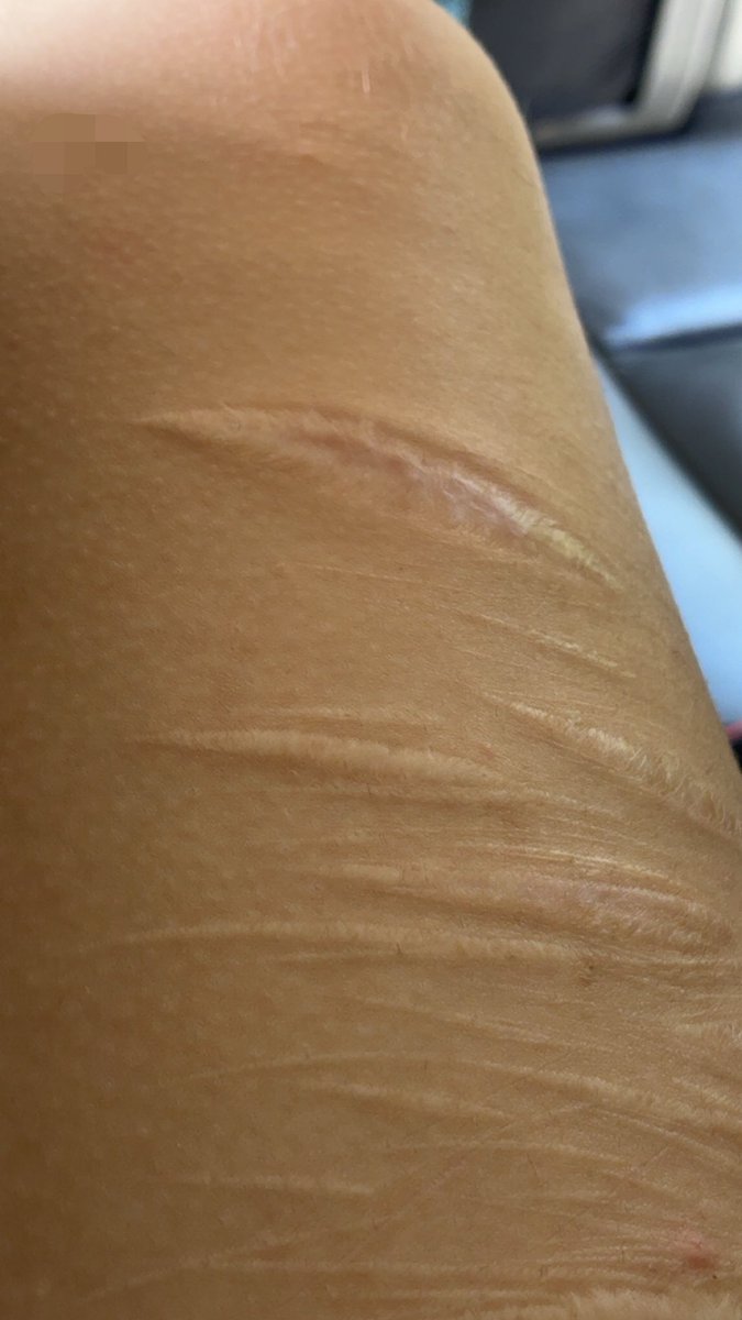 bbbpoltergiests's tweet photo. this scar 👀 https://t.co/3JpJCXuJW8