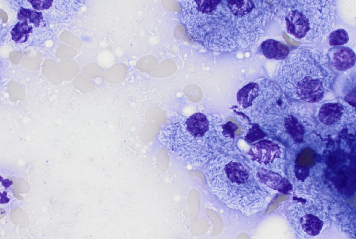 CUHemepath's tweet photo. Occasionally even on the #hemepath service, you can make a diagnosis just on the touch preparation. https://t.co/LmQkVMLnVy