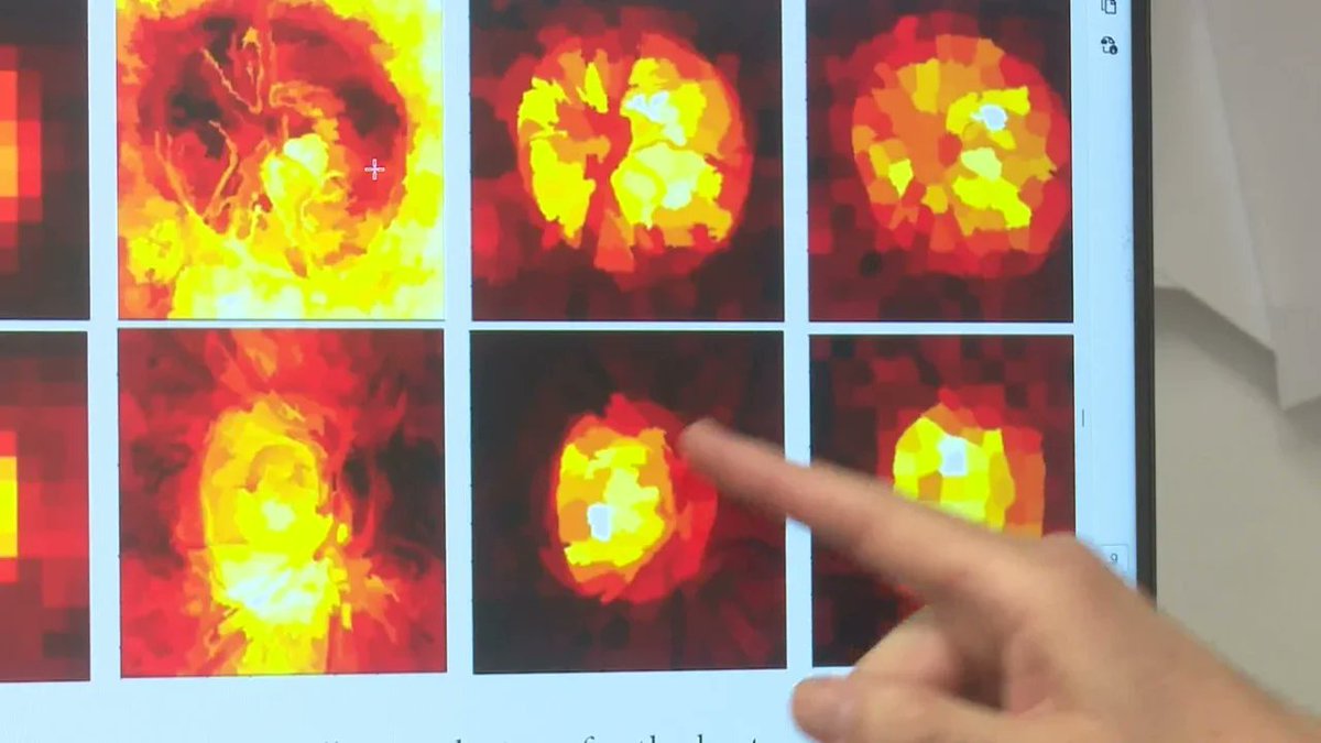 SolDeTamaulipas's tweet photo. ¿Se puede descubrir el glaucoma antes de que avance? La UNAM logra un 95% de precisión con IA. #Glaucoma #IA #SaludVisual https://t.co/jFYsBQSXtw