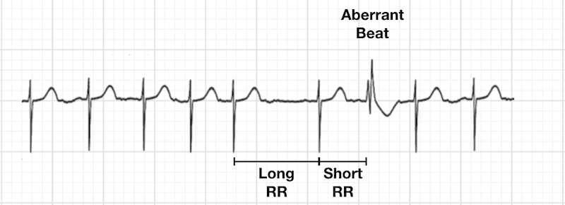AB_drmd's tweet photo. ✅هذا هو الـ Ashman's phenomenon، و هي ظاهرة كهربائية تصير في القلب وتلاحظها وانت تقرا الـ ECG، وأساسها يرجع لمفهوم اسمه aberrant conduction، يعني توصيل كهربائي غير طبيعي داخل الـ ventricles بس مو بسبب مشكلة عضوية في القلب، إنما بسبب اختلاف في الـ refractory period بين الـ bundle branches، ف عشان تفهمها لازم تعرف إن الـ right bundle branch عنده refractory period أطول من الـ left bundle branch بشكل طبيعي، يعني يحتاج وقت أطول عشان يرجع "يتعافى" ويصير جاهز يوصل نبضة كهربائية جديدة، ف لما يصير عندك نبضة قصيرة (short cycle) تجي بعد نبضة طويلة (long cycle)، يعني فيه اختلاف واضح بين طول الـ R-R intervals المتتالية، هذا التغيير المفاجئ يخلي الـ right bundle branch لسا في فترة الـ refractory period بينما الـ left bundle branch خلاص تعافى وجاهز، ف النبضة الجديدة تنتقل عن طريق الـ left bundle branch بس وتوصل متأخرة للـ right side.

هذا يعطيك شكل على الـ ECG يشبه تماما الـ right bundle branch block (RBBB) morphology يعني QRS عريض مع شكل معين في الـ V1 يشبه rSR' وتغيرات بالـ T wave، وأهم شي تعرفه إن هذا الشكل مؤقت وما يمثل مشكلة حقيقية أو دائمة في نظام التوصيل.

📌لو حاب تفهم الحالة اكثر، الفيديو هذا يشرحها بطريقة جميلة: https://t.co/7QQ4mJOR7W