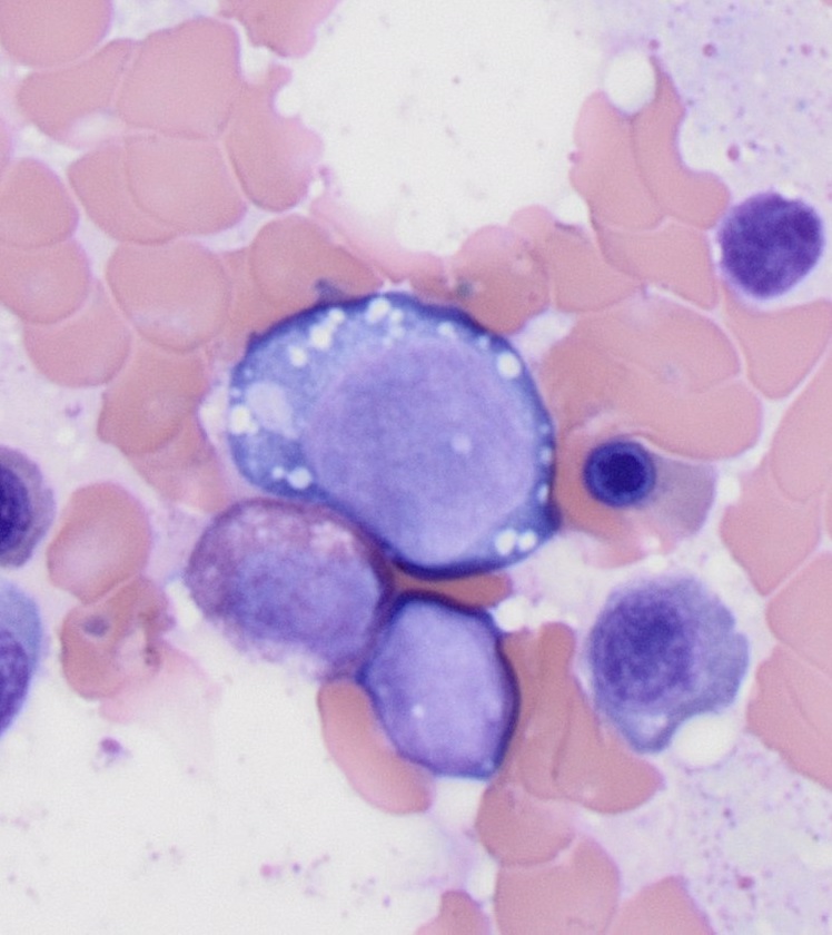 CUHemepath's tweet photo. The cytoplasmic vacuoles raises a ddx of VEXAS, MDS, copper deficiency, and other drug/toxicity related changes. The patient had undetectable levels of copper, and her counts normalized after supplementation. This was a case of copper deficiency associated anemia. https://t.co/0BeNgCpR31