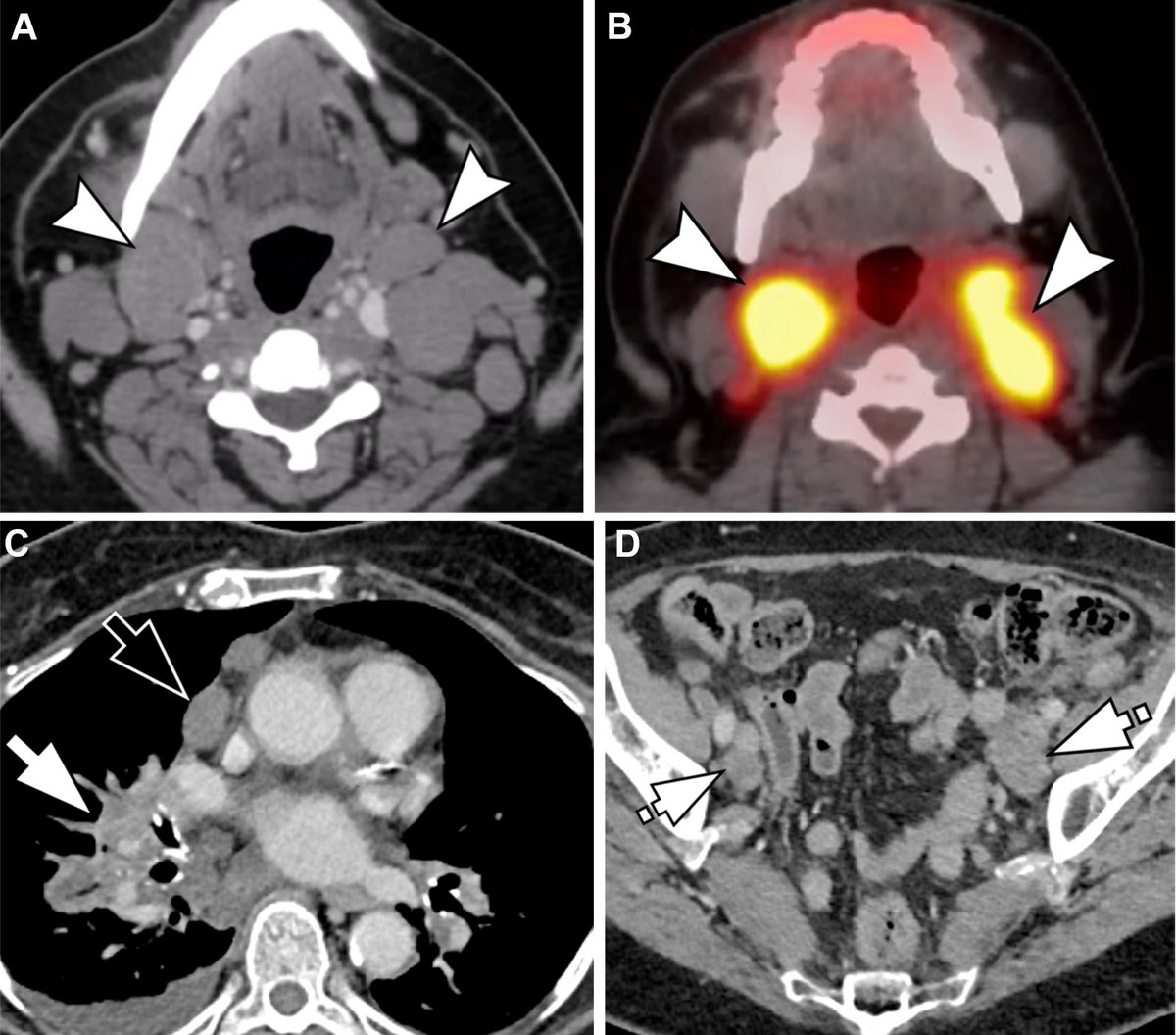 RadioGraphics's tweet photo. Rosai-Dorfman disease often mimics other conditions. This practical review highlights key imaging clues, differential diagnosis, biopsy planning, and the role of targeted therapy https://t.co/w7quZX62In @YashantAswani @driver_zubin @galib4_mirza @skandemirli @WashUMedMIR @IowaRAD https://t.co/ovIRZqAb3L