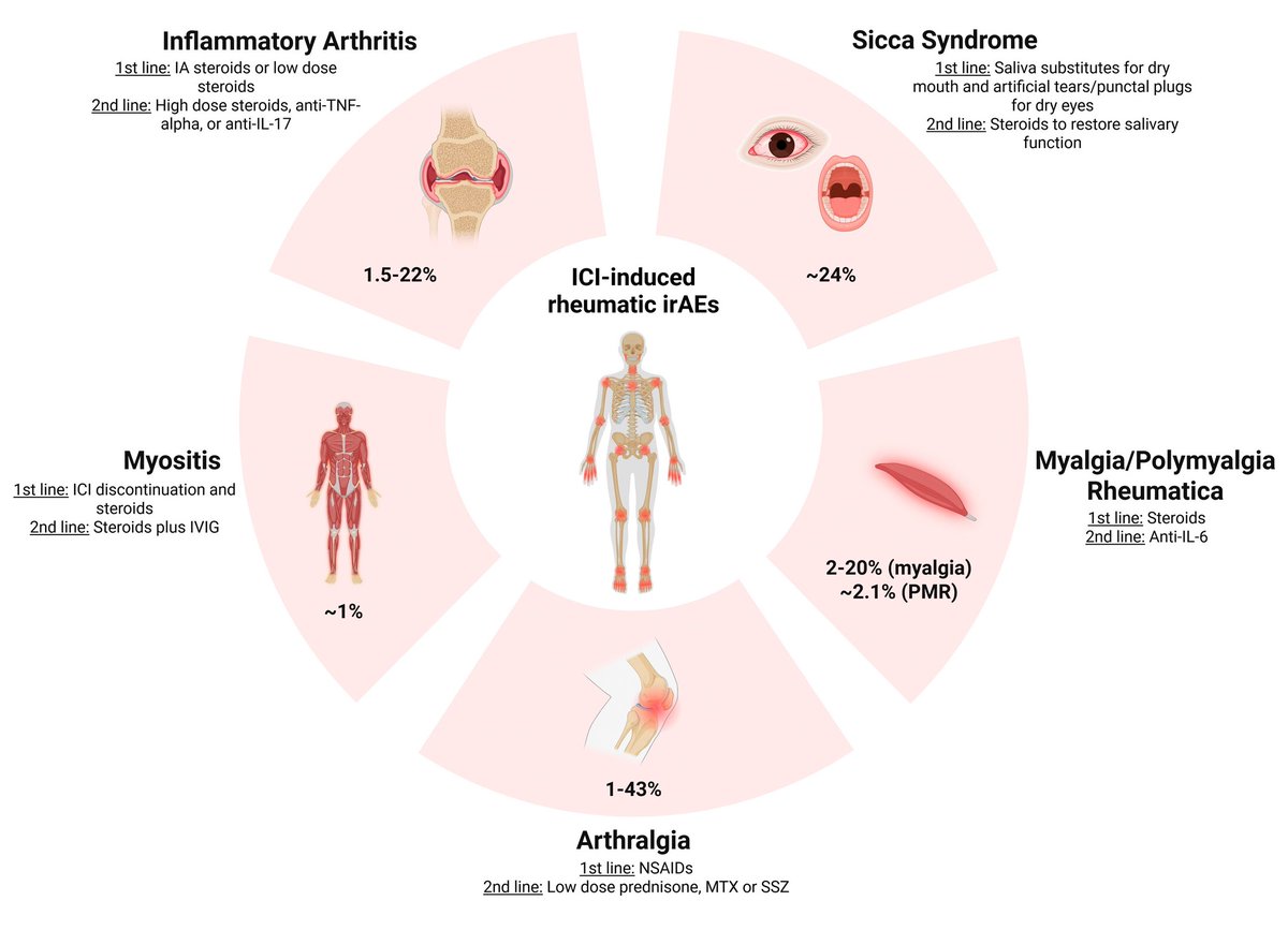 ACR_Journals's tweet photo. Review in ACR Open Rheumatology explores rheumatic phenotypes of ICI toxicity and the current landscape of clinical trials investigating repurposing of DMARDs and biologics for treating ICI-induced systemic inflammatory syndromes

https://t.co/wd52dlYPCL

Image: Rheumatic immune-related adverse events and their treatments