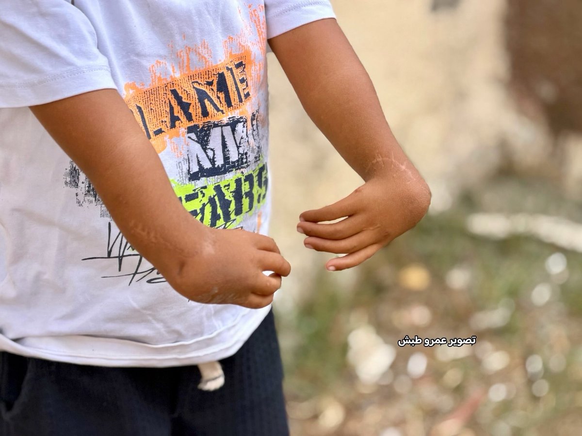 EyeonPalestine's tweet photo. Wajed Abu Awad, 5½ years old, was born with a rare and severe congenital deformity affecting both hands (Radial Club Hands), causing significant hand deviation and the absence of both thumbs. He urgently needs specialized reconstructive surgery abroad to save his hands and restore their function.
 Contact Number: 00972595150613

الطفل واجد أبو عواد (5 سنوات ونصف)، يعاني من تشوه خلقي نادر وخطير في كلا اليدين (Radial Club Hands) مع غياب الإبهامين، وهو بحاجة ماسة لجراحة تخصصية عاجلة في الخارج لتجنب فقدان القدرة على استخدام يديه بشكل دائم وإعاقة مستقبله.
 رقم التواصل مع العائلة: 00972595150613
