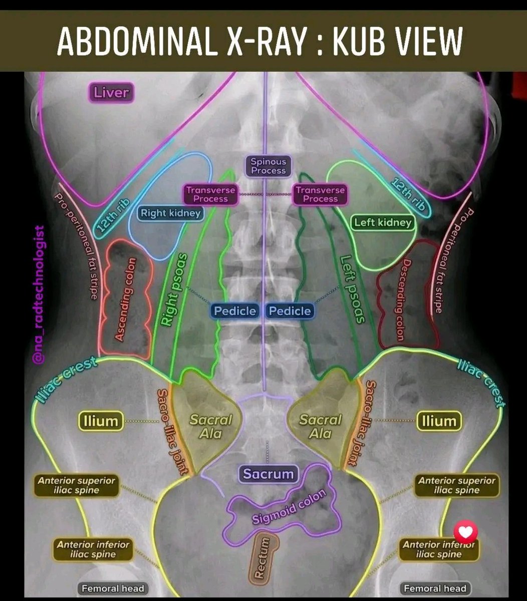 Doctors_GUILD's tweet photo. ABDOMINAL X RAY https://t.co/E59gzRS7H2