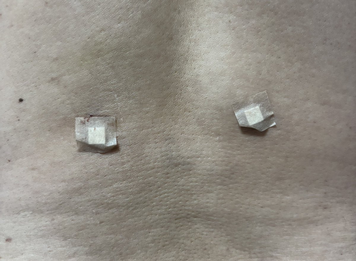 iorior5353's tweet photo. 水曜日にブロック注射を腰に打ってもらいました。
最近、腰に続き、膝も激痛です、、、 https://t.co/HEN7bpkTjV