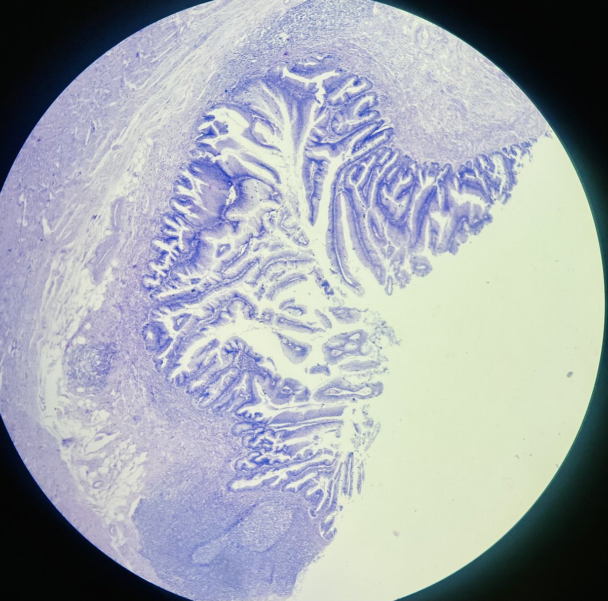 Simrangil128's tweet photo. 67 years female with h/o repeated obstruction.#appendix specimen #pathology case #git https://t.co/RmxPeaQEZk